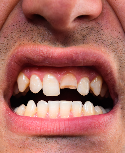 BrokenTooth:Best Dental Care