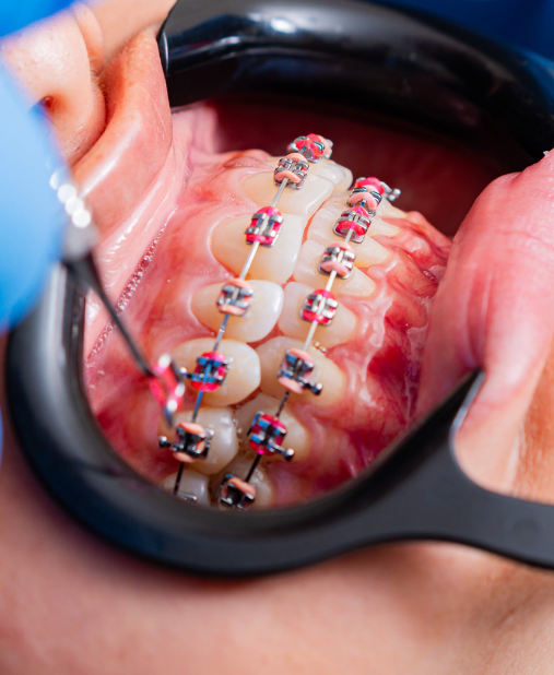 Braces Treatment: Best Dental Care In Bogura