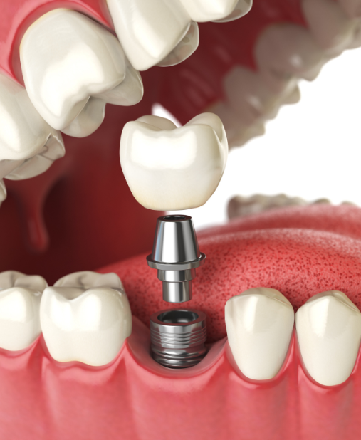 Dental Implants:Best Dental Care