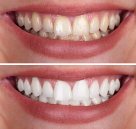 Teeth whitening is used to brighten stained teeth, restoring the natural color of the teeth.