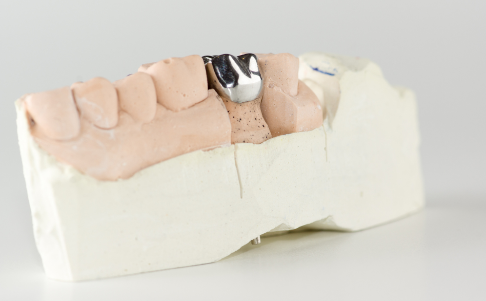 Dental crowns - Bogura best Dental Clinic