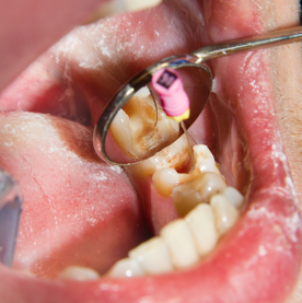 High-quality dental fillings to protect and strengthen damaged teeth