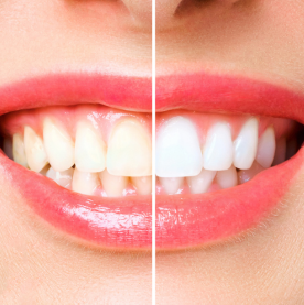 Safe and effective teeth whitening treatment at Namira Oro Dental Care