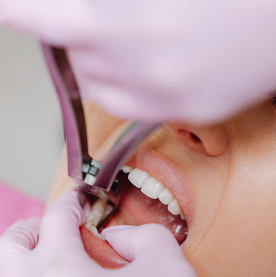 Safe and painless tooth extractions in Bogura at Namira Oro Dental Care by expert dentists